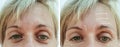Female adult wrinkles removal therapy contrast lift filler patient difference before and after procedures, arrow Royalty Free Stock Photo