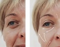 Female adult facial wrinkles rejuvenation treatment mature patient difference before and after procedures, arrow Royalty Free Stock Photo