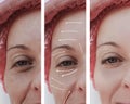 Female adult facial wrinkles rejuvenation mature patient difference before and after procedures, arrow Royalty Free Stock Photo