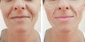 Female adult facial wrinkles rejuvenation filler mature patient difference before and after procedures, arrow Royalty Free Stock Photo