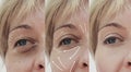 Female adult facial wrinkles rejuvenation treatment mature patient difference before and after cosmetic procedures, arrow Royalty Free Stock Photo