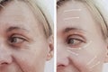 Female adult wrinkles removal dermatology filler patient difference before and after procedures, arrow Royalty Free Stock Photo
