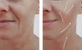 Female adult wrinkles removal rejuvenation dermatology filler patient difference before and after procedures, arrow Royalty Free Stock Photo