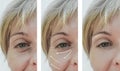 Female adult wrinkles removal rejuvenation filler patient difference before and after procedures, arrow Royalty Free Stock Photo