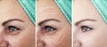 Female aging wrinkles lifting removal results biorevitalization before after treatments Royalty Free Stock Photo
