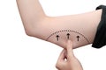 female arm line about to perform liposuction Royalty Free Stock Photo