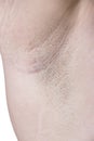 Female Armpit With Irritation Royalty Free Stock Photo