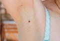 Female armpits with dark hair growing back. Untidiness