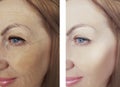 Female eye beauty wrinkles difference before and after dermatology antiaging regeneration treatments