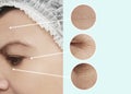 Female  beauty  wrinkles before and after  collage beautician effect tension  treatments Royalty Free Stock Photo