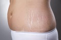 Female belly with pregnancy stretch marks closeup Royalty Free Stock Photo