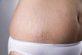 Female belly with stretch marks closeup Royalty Free Stock Photo