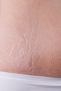 Female belly with stretch marks closeup Royalty Free Stock Photo