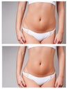 Female body before and after treatment. Plastic surgery. Royalty Free Stock Photo