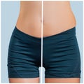 Female body before and after liposuction. Plastic surgery and weight loss Royalty Free Stock Photo