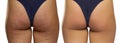 Female buttocks before and after treatment Royalty Free Stock Photo