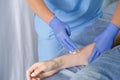 A female doctor beautician makes a procedure shugaring on the right arm of a woman to the patient. Close-up