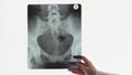 Female doctor hand holds pelvic bones x-ray. Radiologist examines scan against background of light screen or negatoscope