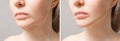 Female double chin before and after correction. Correction of the chin shape liposuction of the neck. The result of the Royalty Free Stock Photo