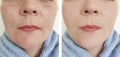 Female elderly wrinkles before difference after effect lifting correction procedures Royalty Free Stock Photo