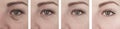Female elderly eyes wrinkles before removal difference after lifting correction procedures Royalty Free Stock Photo