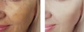 Female eye beauty wrinkles difference before after dermatology antiaging regeneration treatments