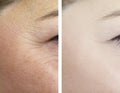 Female eye wrinkles aging ÃÂ¸ before removal and after lift effect difference correction procedures Royalty Free Stock Photo