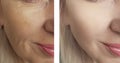 Female eye wrinkles before and after antiaging regeneration treatments Royalty Free Stock Photo