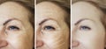 Female eye wrinkles before and after biorevitalization procedures