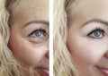 Female eye wrinkles before and after effect difference correction procedures Royalty Free Stock Photo