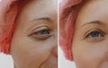 Female eye wrinkles before and after correction regeneration treatments Royalty Free Stock Photo