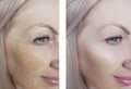 Female eye wrinkles before and after dermatology antiaging regeneration treatments