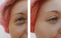 Female eye wrinkles before and after regeneration treatments Royalty Free Stock Photo