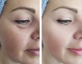 Female eye wrinkles before removal and after lift effect difference correction procedures Royalty Free Stock Photo