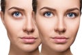 Female eyes with bruises under eyes before and after cosmetic treatment. Royalty Free Stock Photo