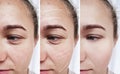 Female eyes wrinkles effect correction before and after treatments
