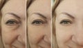 Female face problem wrinkles skin before and after difference lifting procedure rejuvenation treatment collage Royalty Free Stock Photo