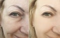 Female face problem wrinkles skin facelift before and after difference lifting procedure rejuvenation treatment collage Royalty Free Stock Photo