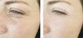 Female face wrinkles before and after procedures