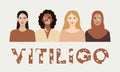 Female faces with vitiligo skin disease banner. World vitiligo day. Portraits with different ethnics, skin colors, hairstyles with
