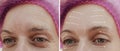 Female facial wrinkles treatment mature difference before and after cosmetic procedures, arrow Royalty Free Stock Photo