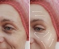 Female facial wrinkles treatment mature patient difference before and after cosmetic procedures, arrow Royalty Free Stock Photo