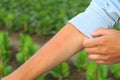 female farmer shows insect bites while working on the farm