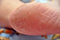 Female feet with callus