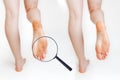 Female feet with dry corn and calluses, on a white background. Leg close-up. Magnified image of skin lesions through a magnifying