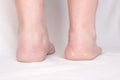 Female feet with spots on a white background with heel spur disease, close-up, plantar fasciitis