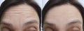 Female forehead wrinkles aging before treatment correction biorevitalization