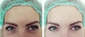 Female forehead wrinkles results correction therapy before and after treatments Royalty Free Stock Photo