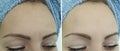 Female forehead wrinkles rejuvenation cosmetology removal before and after aging treatment Royalty Free Stock Photo