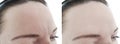 Female forehead wrinkles before and after correction procedures Royalty Free Stock Photo